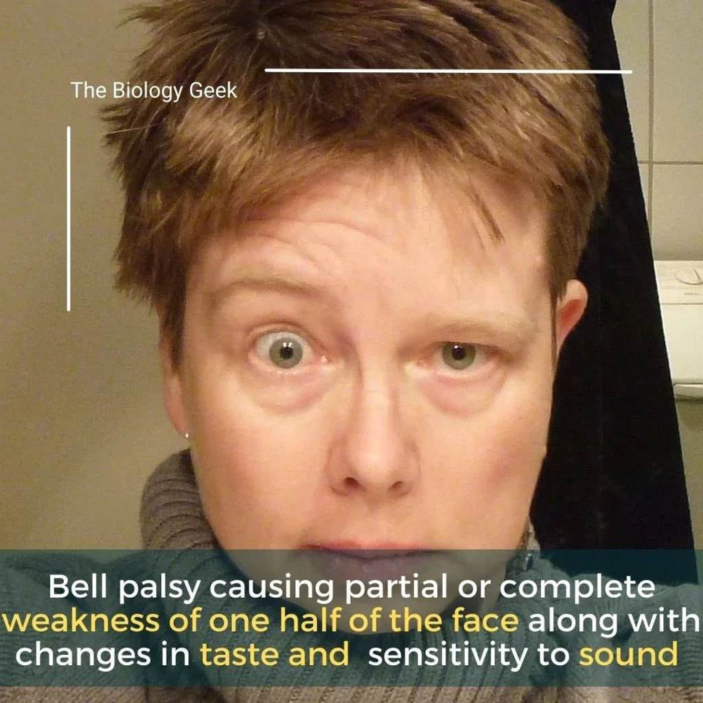 Paralysis symptoms on face 